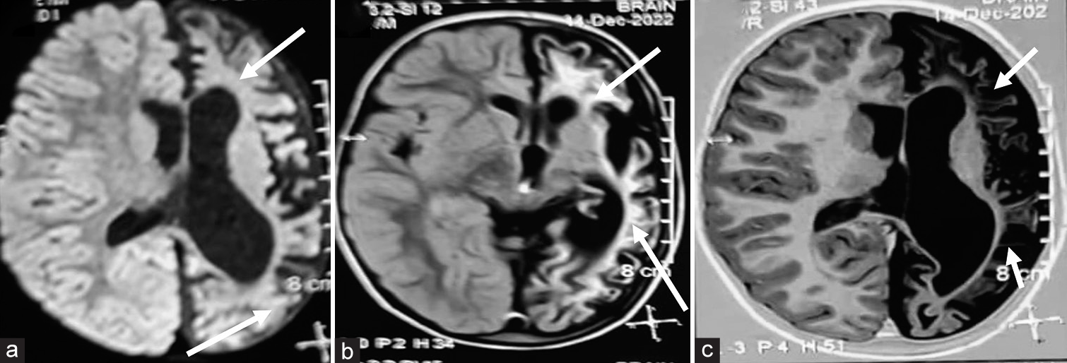 (a-c) Repeat magnetic resonance imaging brain at 4 years. Axial diffusion weighted sequence showing left hemisphere atrophy (thick white arrows) with no restricted diffusion. Diffuse gliotic areas in the left cerebral subcortical white matter appearing hyperintense on axial fluid-attenuated inversion recovery and hypointense (thin white arrows) on T1-weighted sequences.