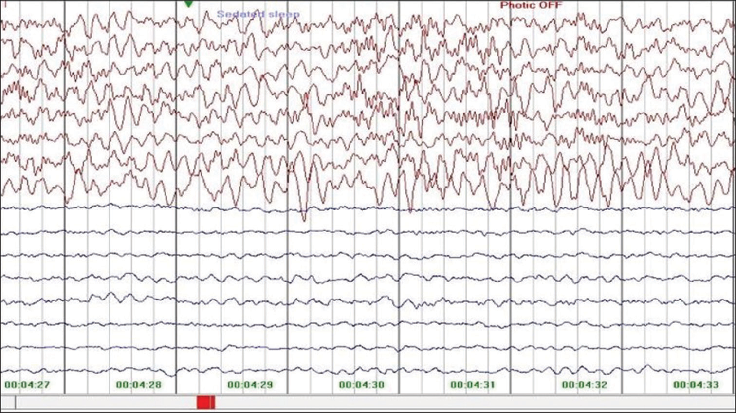 Electroencephalogram of child done at 4 years of age showing low voltage over the left cerebral hemisphere during follow-up at 4 years of age.