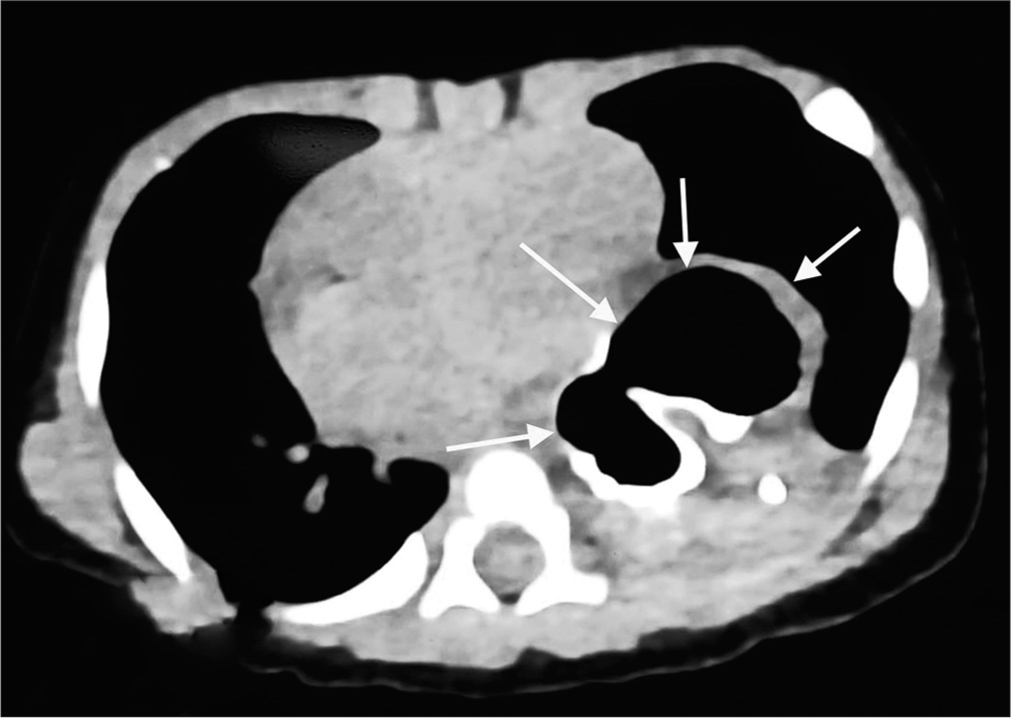 High-resolution computed tomography chest showing the stomach (marked by white arrows) behind the heart shadow.