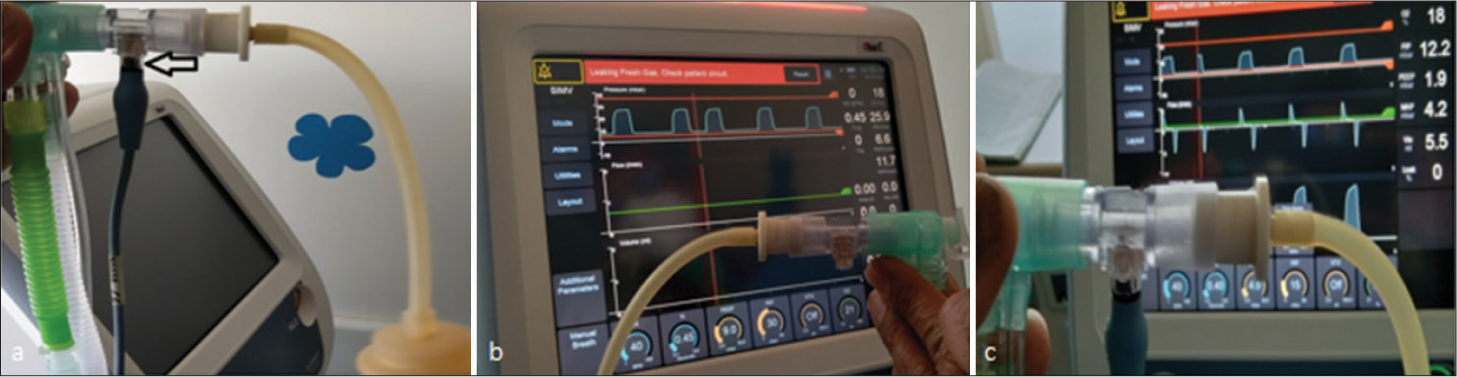 (a) The flow sensor-heated wire anemometer is a data link between the patient and the machine (arrow). (b)The monitor shows the pressure-time curve only when the sensor is not attached. (c)With an intact sensor, the flow and volume curves are also seen.