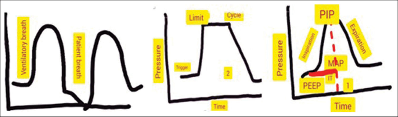 Characteristics of breath (ventilator and patient breath). (2) Trigger (cause for breath to begin), limit (cause for regulation of breath), cycle (cause for breath to end), and (1) the mean alveolar pressure. PEEP: Peak end-expiratory pressure, PIP: Peak inspiratory pressure, MAP: Mean alveolar pressure. The red- line represents IT. IT is inspiratory time. Until the dotted line is the inspiratory phase.