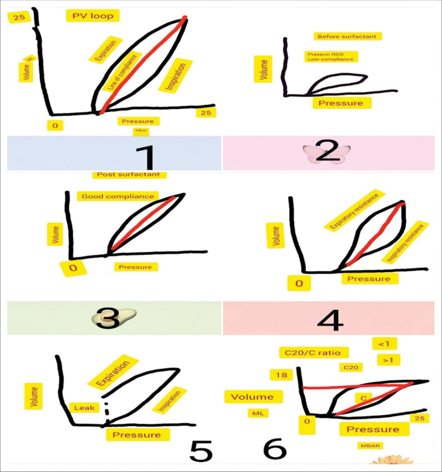 (1) Normal pressure-volume loop, (2) Low compliance loop as seen in pre-term respiratory distress syndrome with low compliance, (3) Good compliance loop post-surfactant administration, (4) Loop showing inspiratory and expiratory resistance, (5) Loop showing Endotracheal tube (ET) leak, (6) Loop showing beaking phenomena indicating hyperinflation of alveoli. The C20/C ratio is the ratio between the last 20% of the compliance to the total compliance. A ratio of more than one is normal, and <1 indicates hyperinflation. Pressure 0-25, C is compliance MBAR is the millibar.