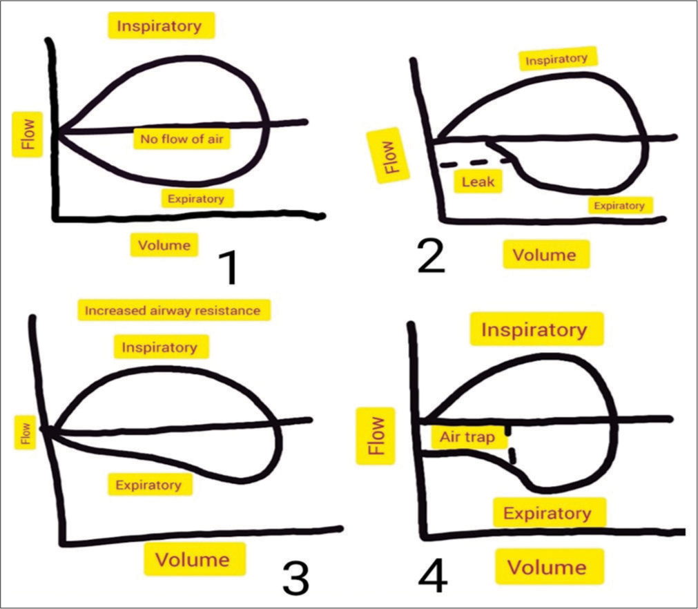 (1) Flow-volume curve showing normal (the inspiratory and expiratory flow come and join the same point where no airflow happens), (2) expiratory leak (the expiratory volume does not return to the zero volume level and the volume of leak indicates the magnitude), (3) increased expiratory resistance (scooped out expiratory tracing), (4) air trap (the expiratory trace does not return to baseline).