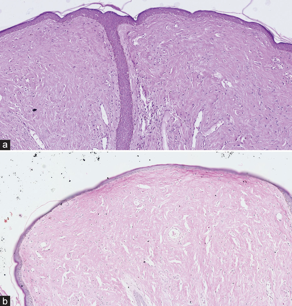 (a) Homogenous, eosinophilic deposits in the papillary dermis, with epidermal atrophy (Hematoxylin and eosin (H&E), ×10). (b) Periodic acid-Schiff positivity in the papillary dermis (×10).