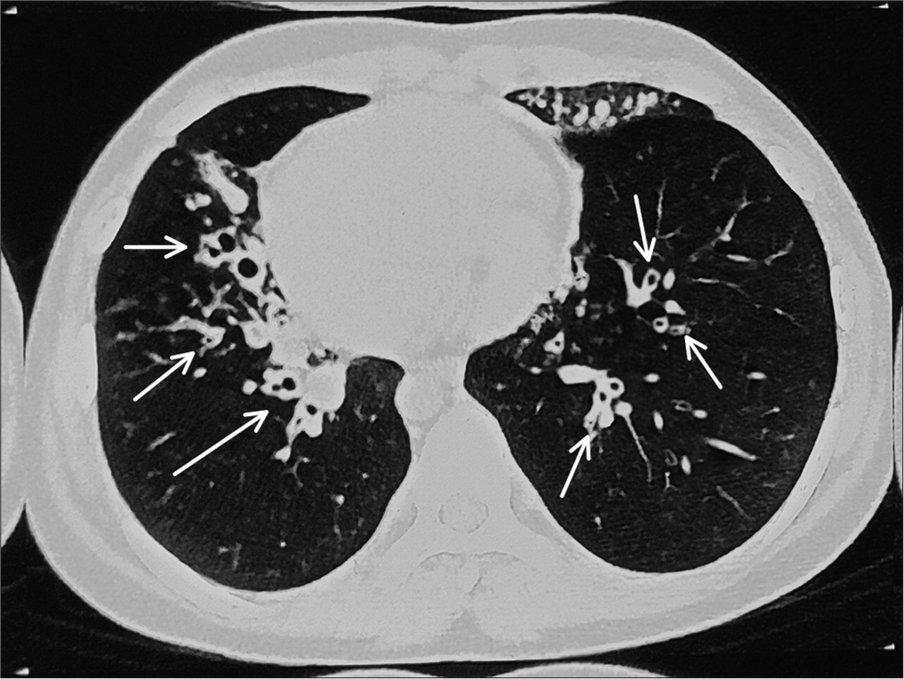 High-resolution computed tomography showing bilateral central cylindrical and varicose bronchiectatic changes with extensive mucosal plugging (shown as white arrow) with centrilobular benching nodules in bilateral lungs suggestive of infective bronchiolitis.