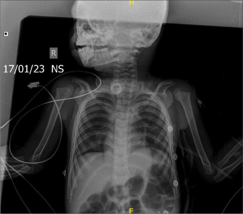 X-ray taken after removal of the broken tracheostomy tube.