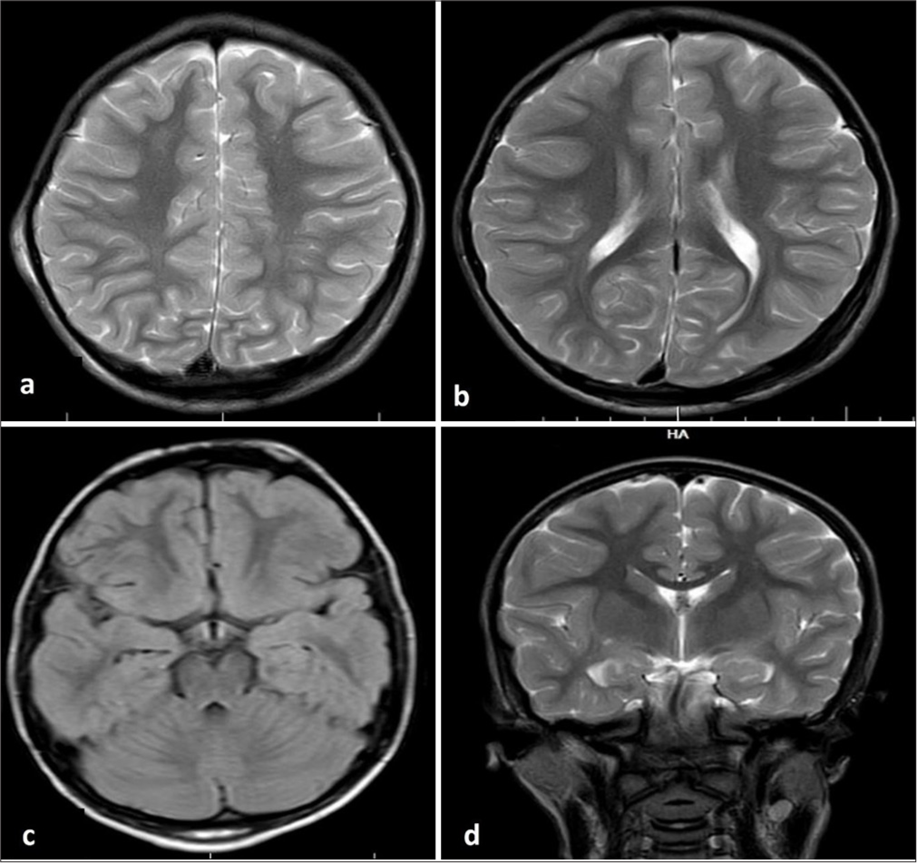 (a-d) Magnetic resonance imaging of the brain not showing any abnormalities.