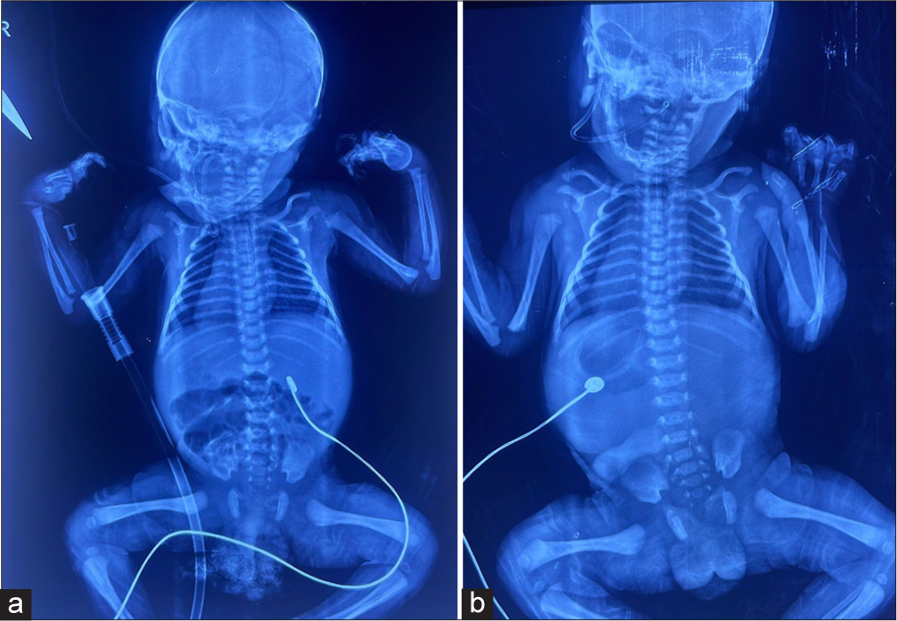 (a) Situs inversus totalis and (b) situs inversus totalis-shift of cardiac and liver.