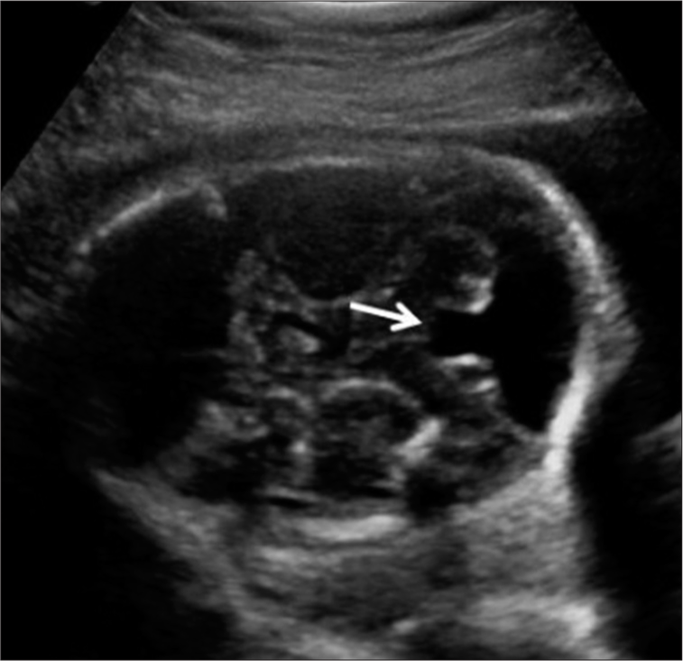 Vermian hypoplasia transcranial ultrasound. Vermian hypoplasia- indicated through an arrow.