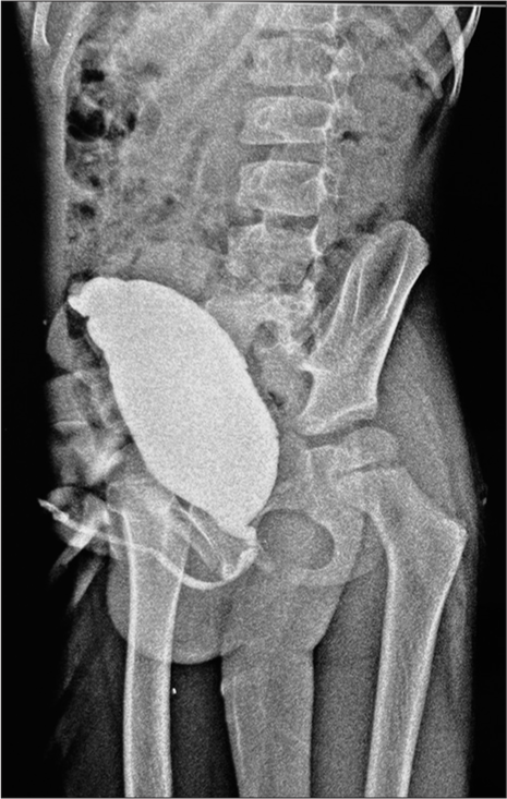 Micturating cystourethrogram shows an enlarged bladder depicting a neurogenic bladder.