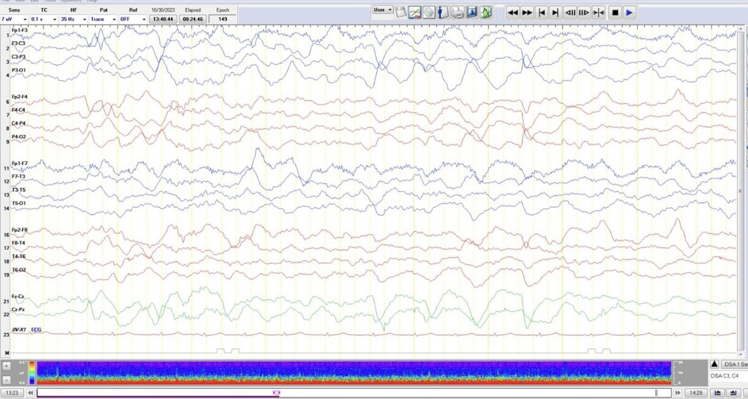Electroencephalogram: Background was abnormal with slowing suggesting encephalopathy. There was no evidence of any epileptiform activity.