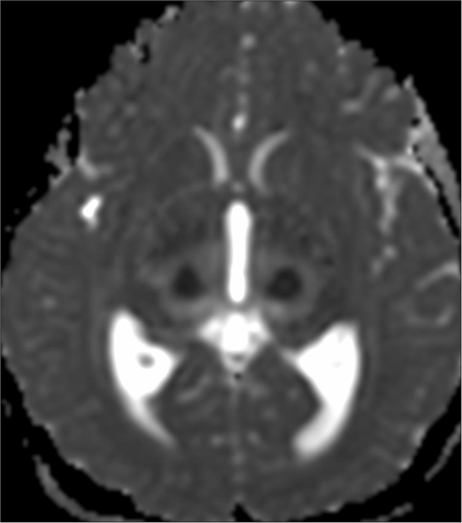 Magnetic resonance imaging brain: Apparent diffusion coefficient images showing trilaminar pattern of diffusion restriction in bilateral thalami.