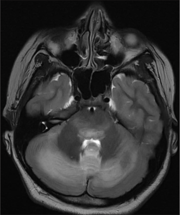 Magnetic resonance imaging brain T2 hyperintense areas in brainstem.