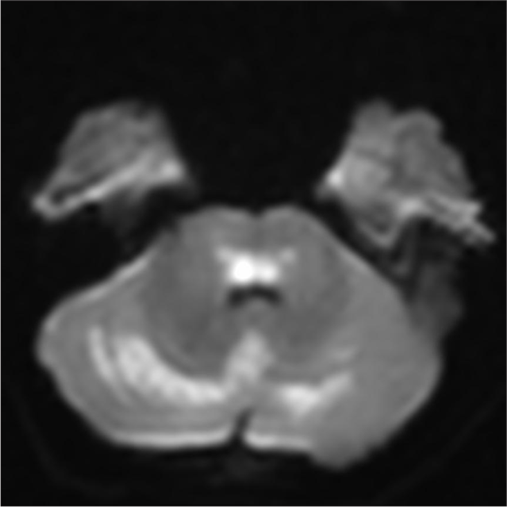 Brain T2 hyperintense areas in bilateral cerebellar hemisphere showing diffusion restriction.