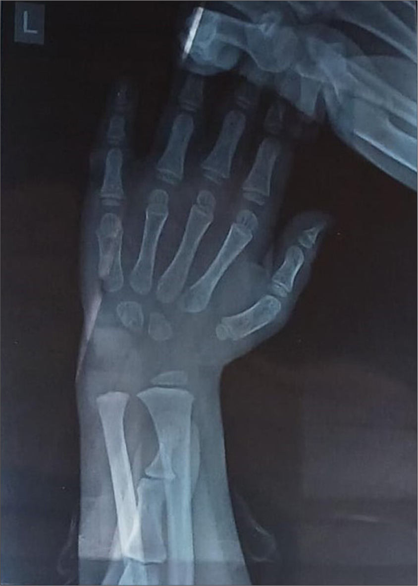 Left hand wrist X-ray showing only two carpal bones.