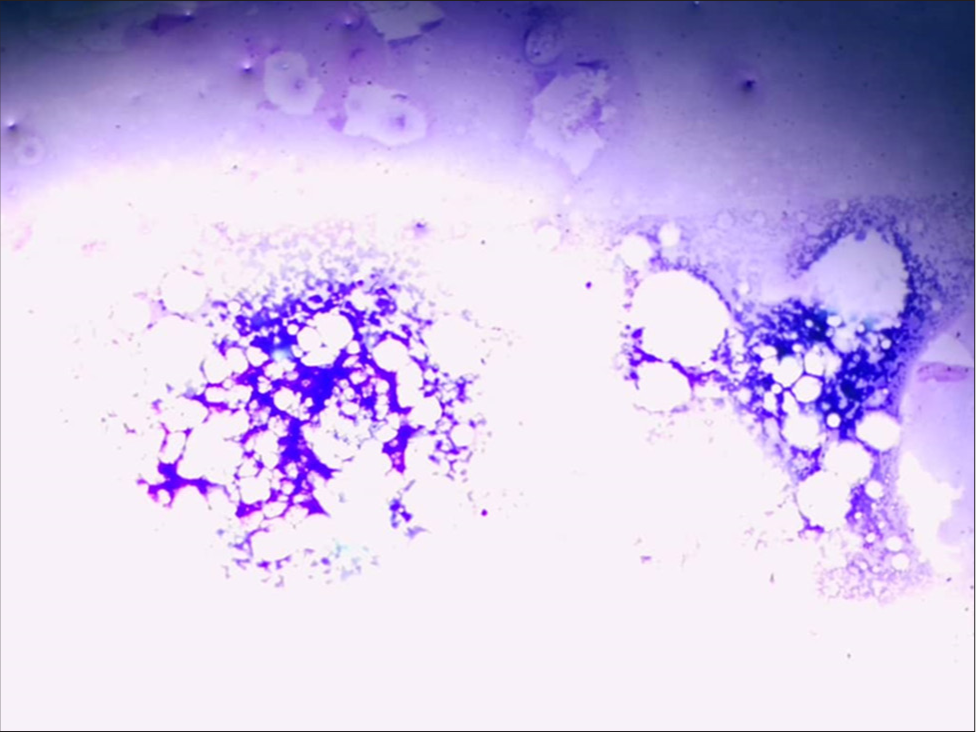 Bone marrow showing hypocellularity. (Giemsa Stain magnification x10).