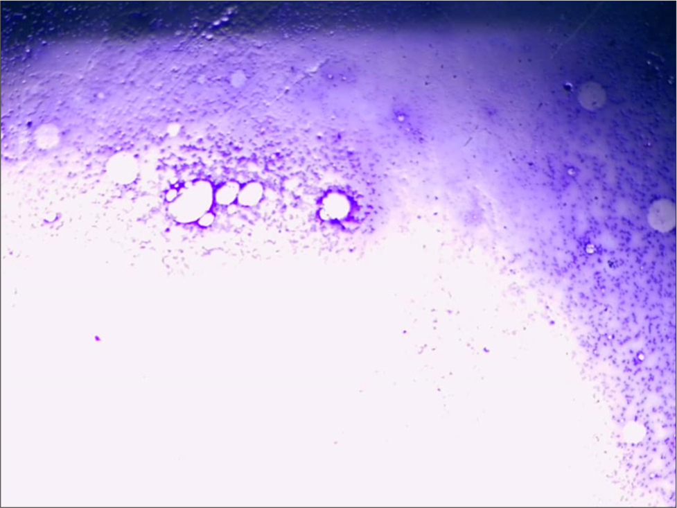 Bone marrow showing hypocellularity. (Giemsa Stain, Magnification x10).