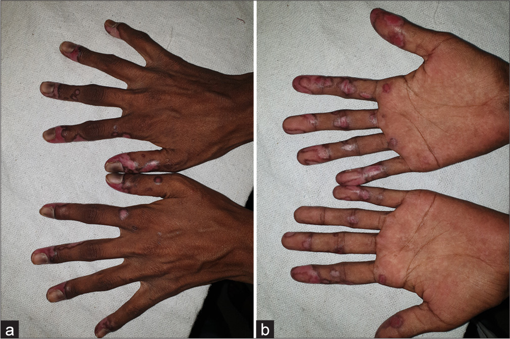 (a) Well-defined, erythematous to violaceous scaly plaques with surrounding hyperpigmentation on the dorsal and (b) ventral surface of bilateral hands.