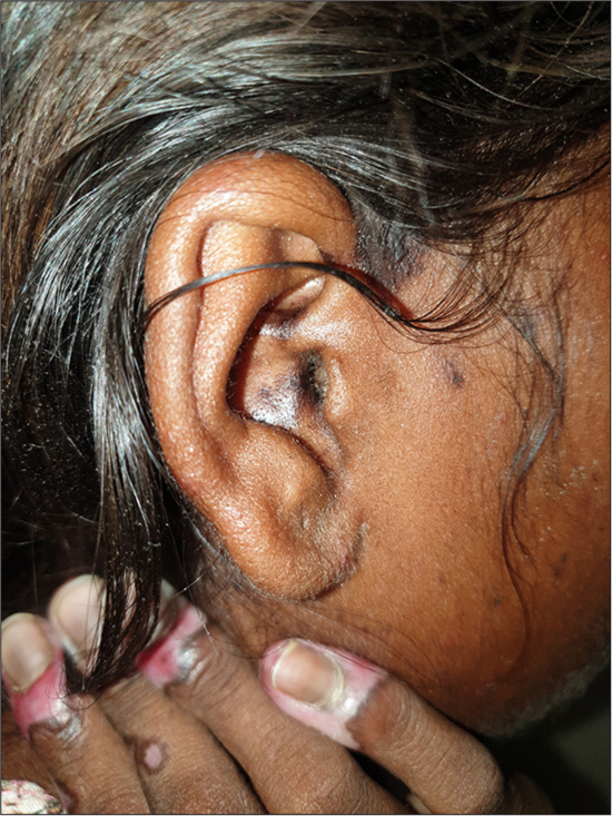 Hyperpigmented plaque with follicular plugging involving the concha of the ear.