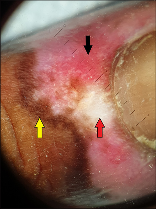 Dermoscopy of the lesion on the right hand showing cicatricial milky red areas (black arrows), structureless white patches (red arrow) and a peripheral pigmented network (yellow arrow) (Heine Delta 20T dermatoscope, non-polarised contact mode, ×10).