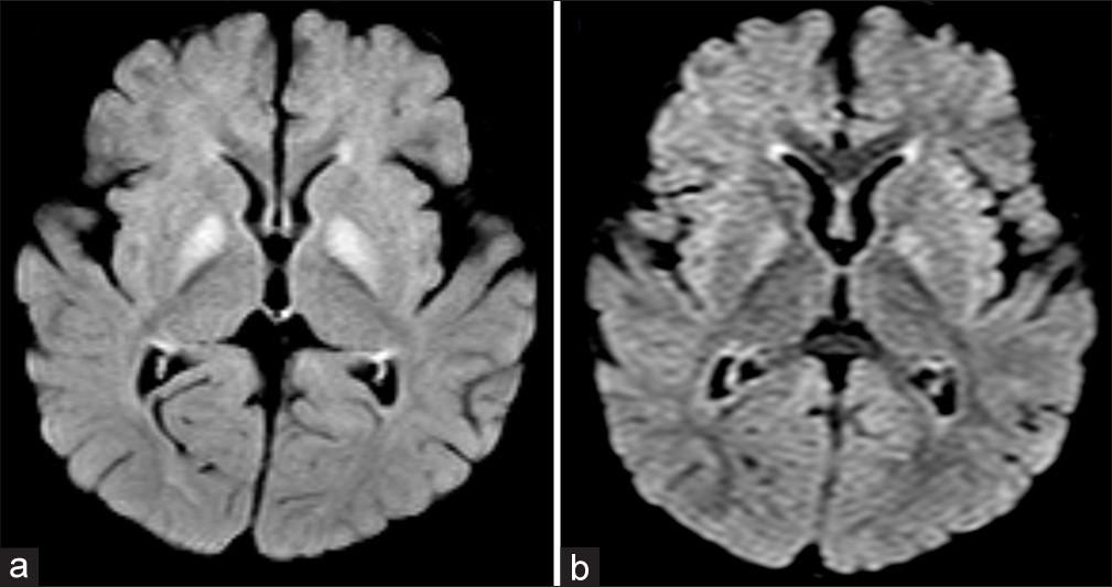 (a) Axial fluid-attenuated inversion recovery image shows hyperintensity in bilateral globus pallidi with mild swelling. (b) Axial diffusion-weighted image shows mild hyperintensity suggestive of restricted diffusion.